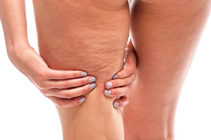 Protocolo para celulitis: guía paso a paso para tratamientos estéticos