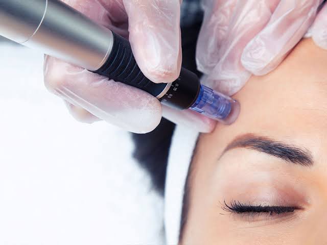 Dermapen vs Dermaroller: diferencias, ventajas y cuál elegir