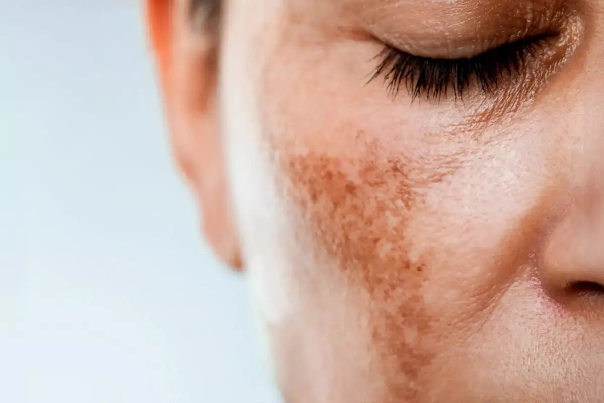 Melasma: qué es, por qué aparece y cómo tratarlo correctamente