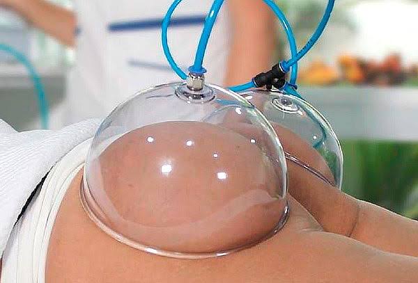 Vacumterapia: qué es, cómo funciona y para qué sirve